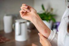 

Guide d'urgence : Que faire en cas de brûlure grave ?

