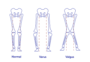 Diagrams of leg misalignments