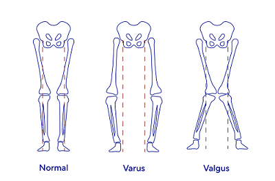 Risk factors for knee osteoarthritis