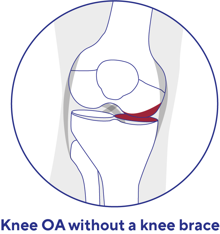 Osteoporose