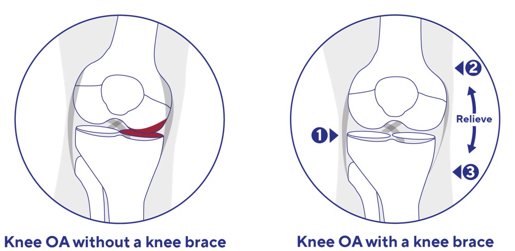 Osteoporose