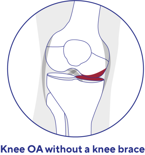Osteoporose