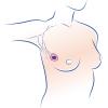 Breast tumorectomy
